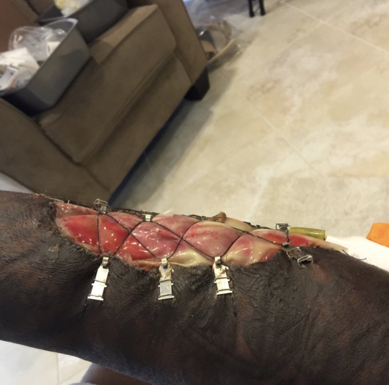 Jason Pierre-Paul Shares Extremely Graphic Images Of Mangled Hand As July 4th Warning ...1242 x 1231