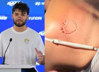 Puka Nacua’s Victim’s Lawyer Releases Photo Showing Severity Of Bite Mark He Left On Woman