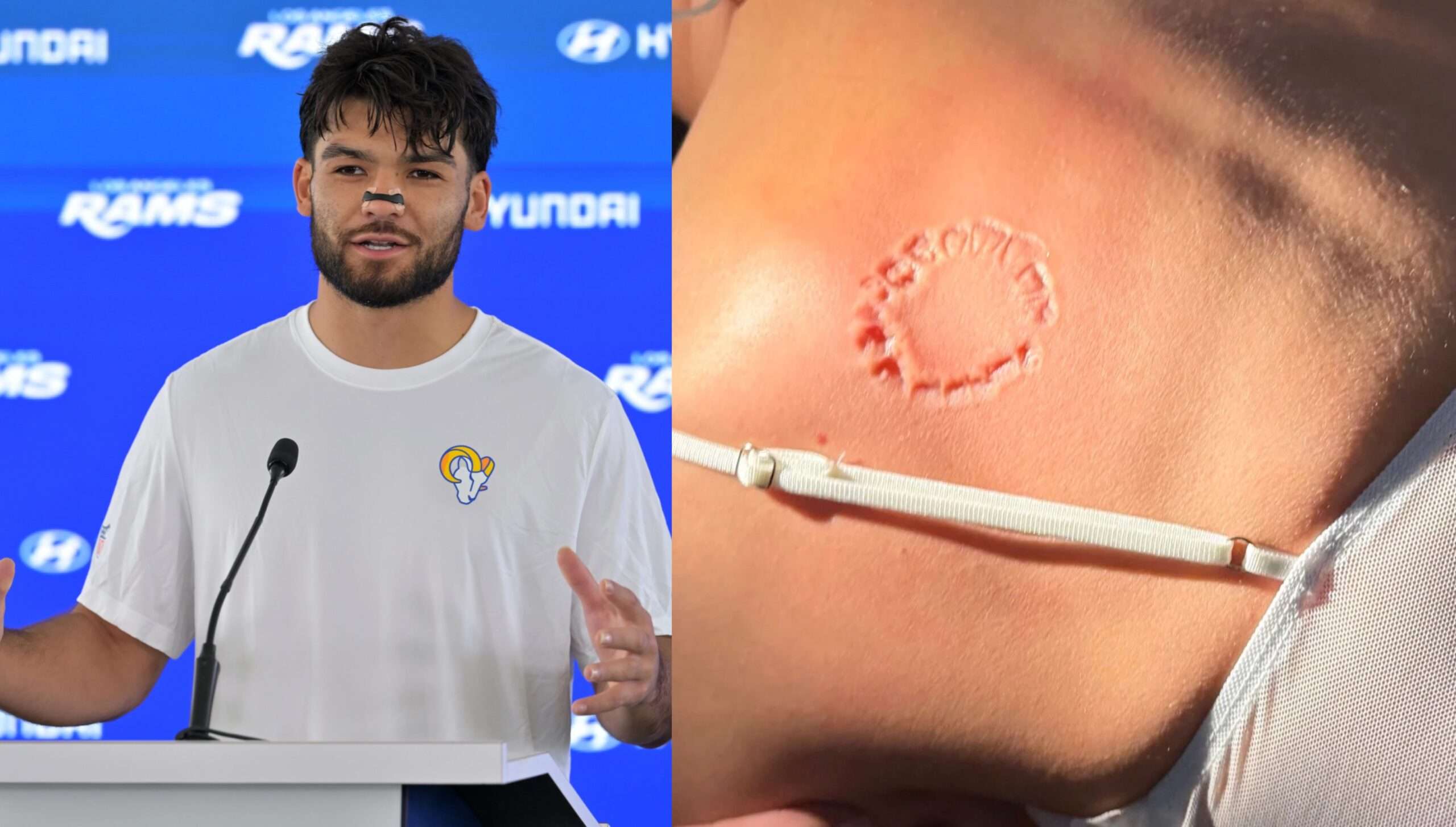 Puka Nacua's Victim's Lawyer Releases Photo Showing Severity Of Bite Mark He Left On Woman (PIC)